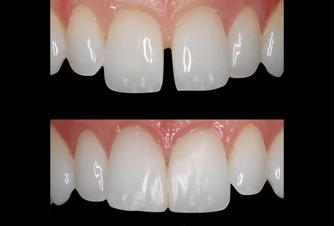 2-Composite Bonding