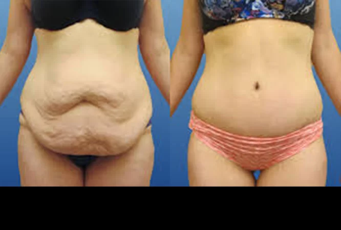 Abdominoplasty