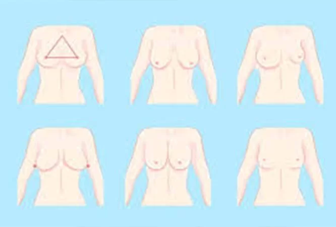 Breast Asymmetry Correction