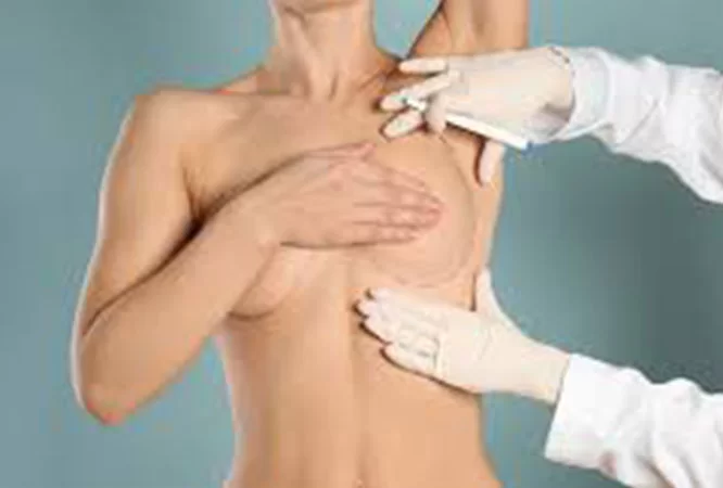 Breast Lift