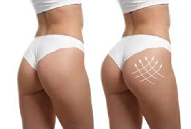 Buttocks Augmentation