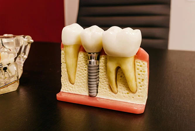 Dental implants