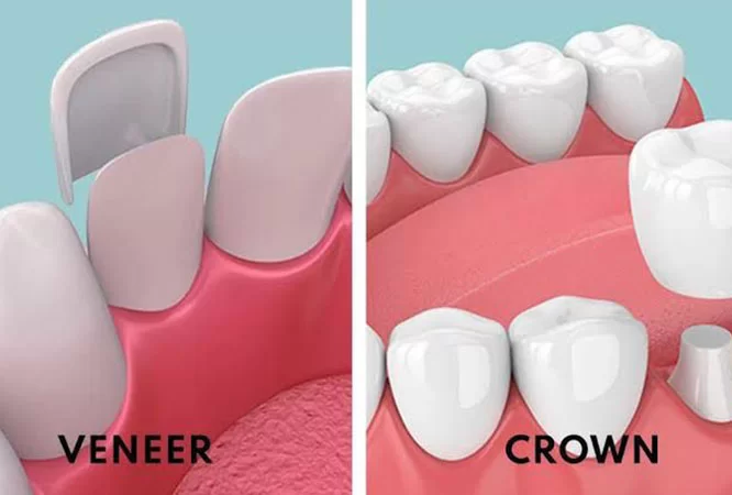 E-Max Veneers