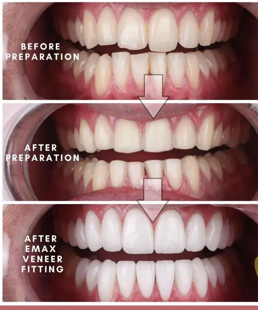 E-Max Veneers