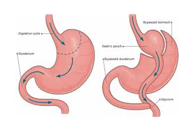 Gastric Bypass