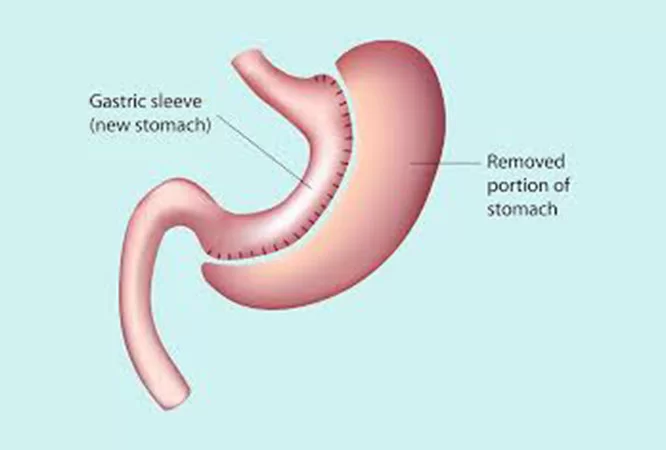 Gastric Sleeve