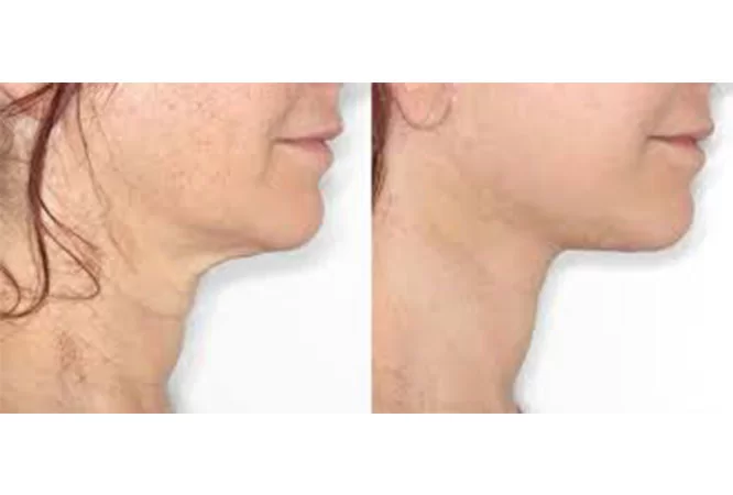 Neck Lift