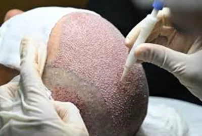 DHI Hair Transplant