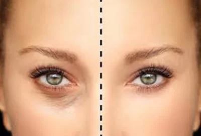 Eyelid Surgery