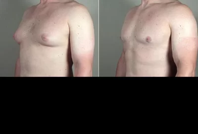 Gynecomastia