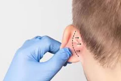 Ear Surgery (Otoplasty)