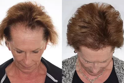 Women’s Hair Transplant